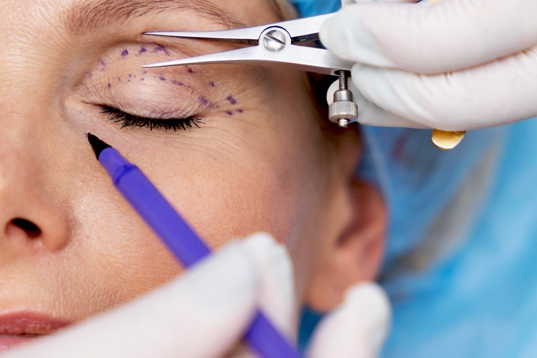 Marcação cirúrgica para Blefaroplastia Superior