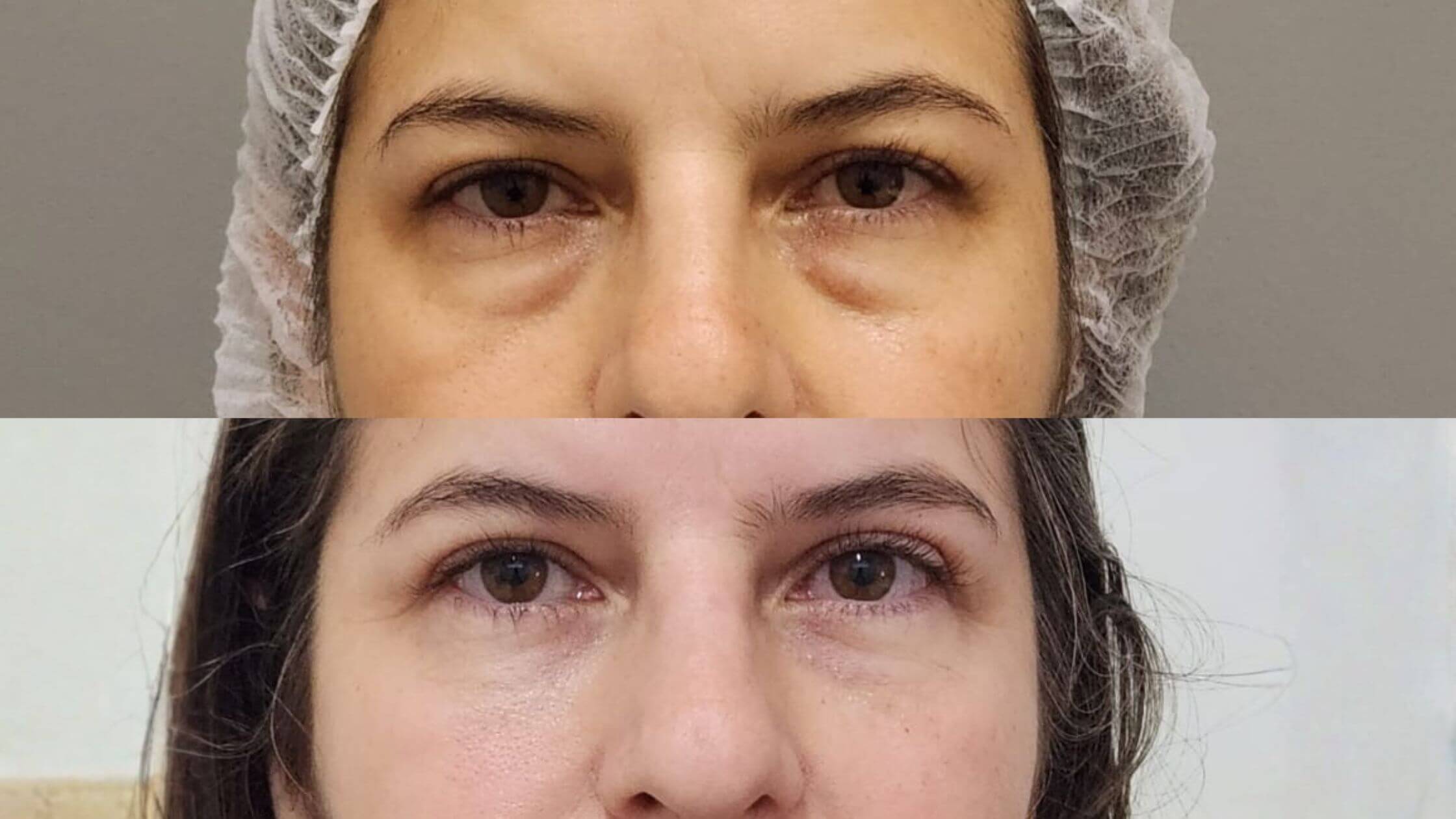 Antes e depois da Blefaroplastia - paciente real Clínica Castanhares